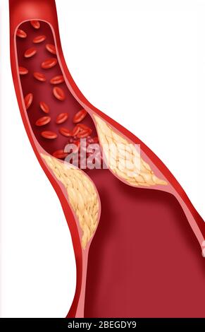 Thrombosis Stock Photo