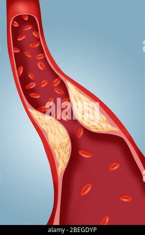 Atherosclerosis Stock Photo