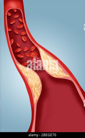 Thrombosis Stock Photo