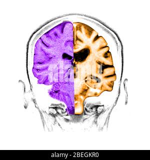 Normal / Alzheimer's Brain Comparison Stock Photo