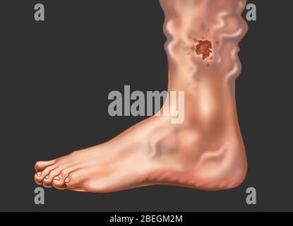 Skin Ulcer from a Varicose Vein on the Ankle Stock Photo - Alamy