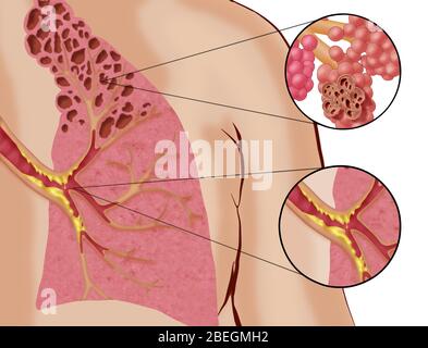 Chronic Obstructive Pulmonary Disease (COPD) Stock Photo