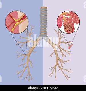 Chronic Obstructive Pulmonary Disease (COPD) Stock Photo