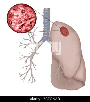 Pneumocystis Jirovecii Stock Photo