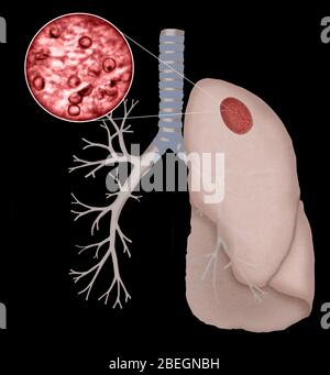 Pneumocystis Jirovecii Stock Photo