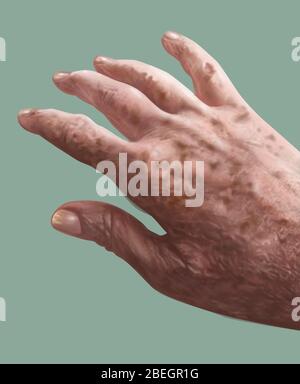 Lentigo or Liver Spots Stock Photo