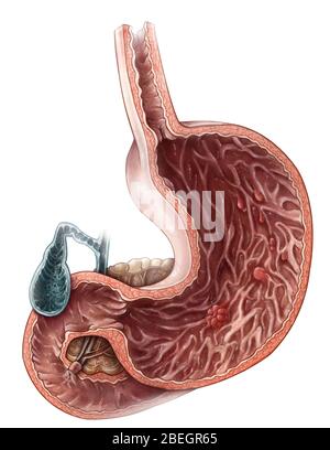 Stomach Polyps Stock Photo