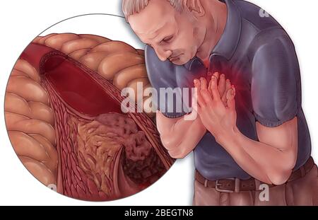 Heart Attack and Atherosclerosis Stock Photo