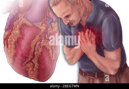 Heart Attack Stock Photo