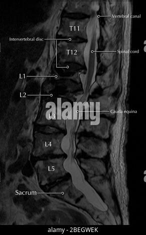Lumbar Compression Fracture Stock Photo