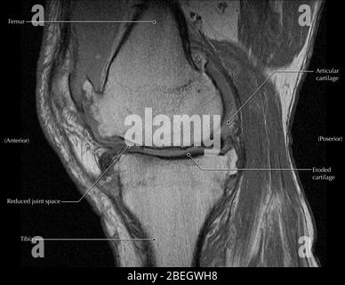 Knee Arthritis, MRI Stock Photo