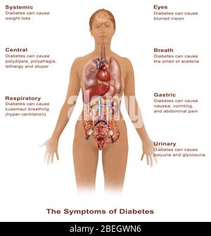 Symptoms of Diabetes Stock Photo