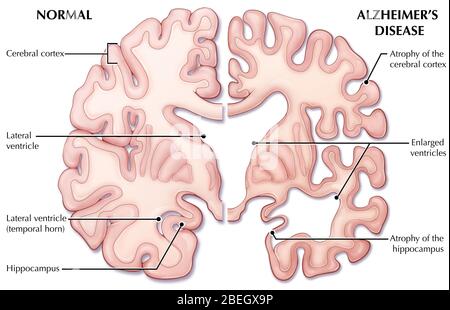 Alzheimer's Disease Brain Comparison Stock Photo - Alamy