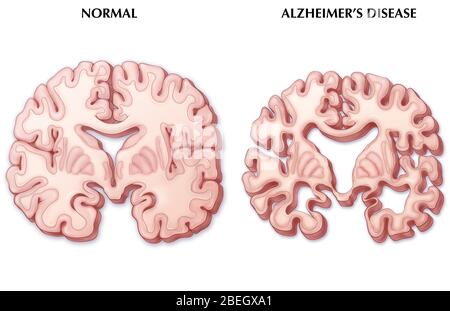 Alzheimer's Disease Brain Comparison Stock Photo - Alamy