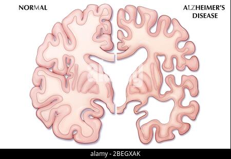 Alzheimer's Disease Brain Comparison Stock Photo - Alamy