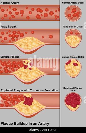 Diagram showing plaque build-up within an artery. From top to Stock ...