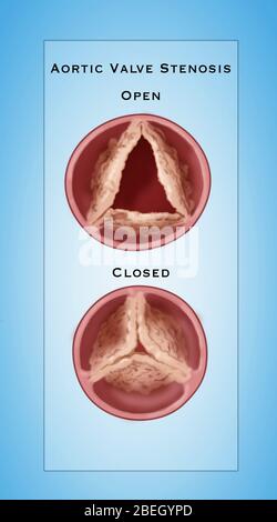 Illustration of aortic valve stenosis, a heart condition in which the ...