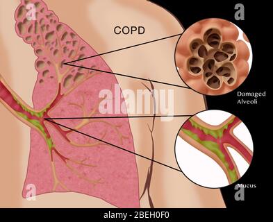 Chronic Obstructive Pulmonary Disease Stock Photo