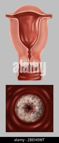 Late Stage IB Cervical Cancer Stock Photo