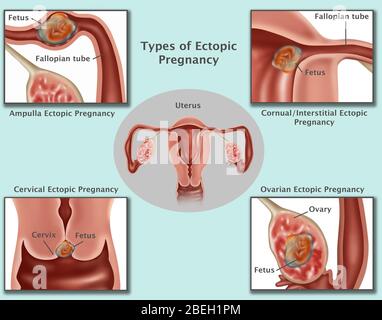 Illustration of common ectopic pregnancies. Pregnancies occurring in the Ampulla (top left), Interstitial Fallopian Tube (top right), cervix (bottom left), and the ovary (bottom right). As the ectopic pregnancy develops, the growing embryo may rupture the surrounding tissues causing serious bleeding. Surgery is usually performed to remove the embryo, and to repair or remove the area of implantation. Stock Photo