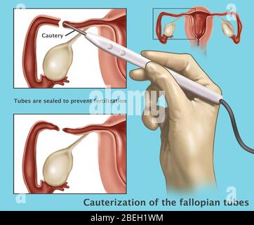 Cauterization of the Fallopian Tubes Stock Photo