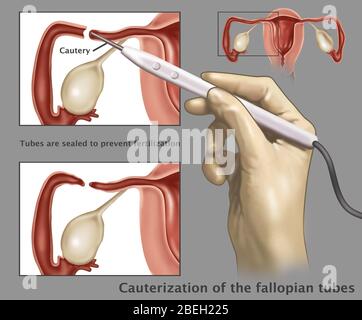 Cauterization of the Fallopian Tubes Stock Photo