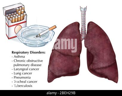 An illustration depicting cigarettes and a pair of lungs affected by smoking. A number of respiratory disorders are causally linked to smoking, including asthma, chronic obstructive pulmonary disease, laryngeal cancer, lung cancer, pneumonia, tracheal cancer, and tuberculosis. The lungs can develop a dark or decayed appearance due to the accumulation and exposure to tar and other chemicals found in cigarettes. Stock Photo