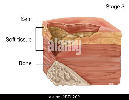 4 Stages of a Bedsore, Illustration Stock Photo - Alamy