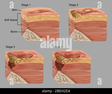 4 Stages of a Bedsore, Illustration Stock Photo