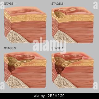 4 Stages of a Bedsore, Illustration Stock Photo