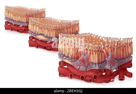 Age-related Macular Degeneration, Illustration Stock Photo