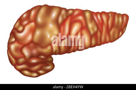 Illustration of an inflamed pancreas (Pancreatitis). Pancreatitis may be acute or chronic, but either type can be very severe and have serious complications. Stock Photo