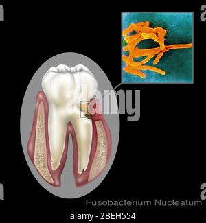 Oral Infection of Fusobacterium Nucleatum Stock Photo