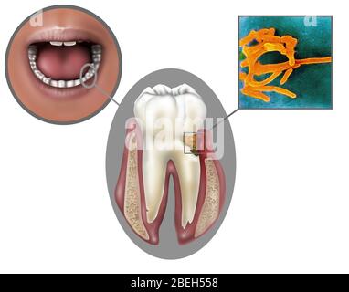 Oral Infection of Fusobacterium Nucleatum Stock Photo