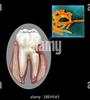 Oral Infection of Fusobacterium Nucleatum Stock Photo