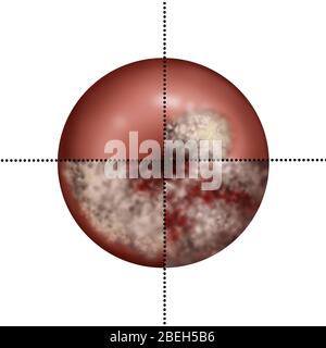 Cervical Cancer Progression, Illustration Stock Photo