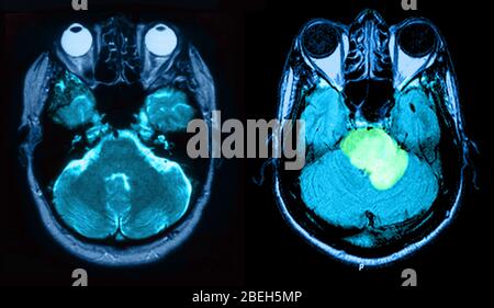 MRI of Normal Brain and Acute MS with Edema Stock Photo