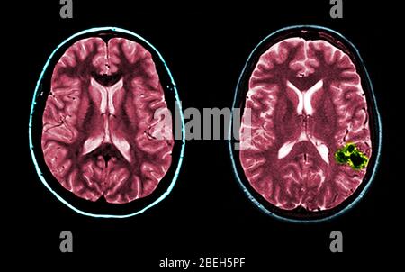 MRI of Normal and AVM Brains Stock Photo