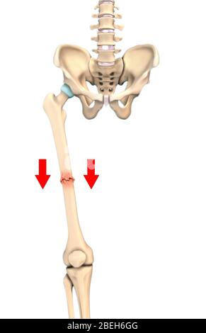 Impacted Bone Fracture, Illustration Stock Photo - Alamy