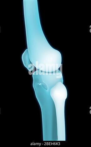 Knee Bones, Lateral View Stock Photo