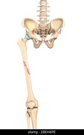 Oblique Bone Fracture, Illustration Stock Photo