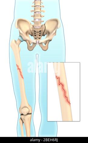 An illustration of an oblique fracture in which a break is diagonal to the bone's long axis. Stock Photo