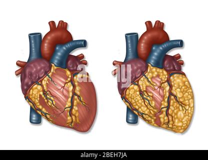 Comparison of a normal heart artery and an artery with plaque, a cause of angina. Illustration. Stock Photo