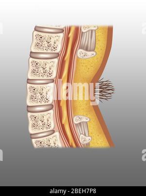 Spina Bifida Occulta, Illustration Stock Photo