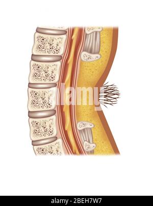 Spina Bifida Occulta, Illustration Stock Photo