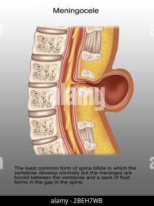 Spina Meningocele, Illustration Stock Photo