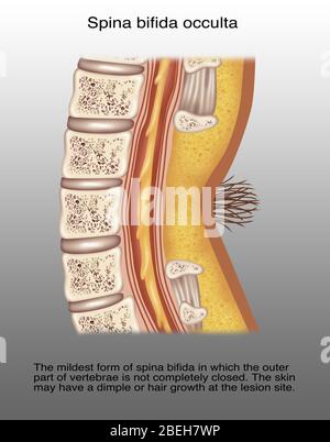 Spina Bifida Occulta, Illustration Stock Photo