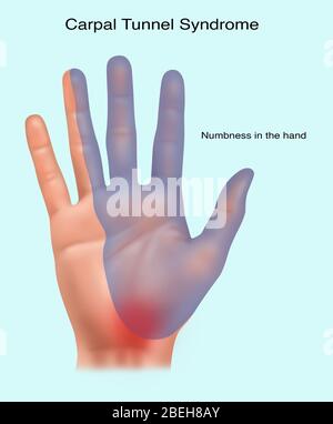 Illustration depicting carpal tunnel syndrome. Carpal tunnel happens when the median nerve is compressed at the wrist, and results in pain or numbness. Numbness is occurring in the blue area of the hand. Stock Photo