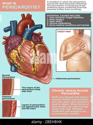 Pericarditis Brochure, Illustration Stock Photo