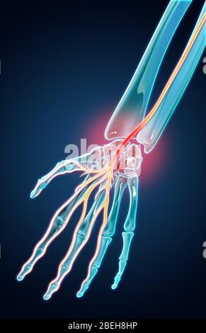 Carpal Tunnel Syndrome, Illustration Stock Photo